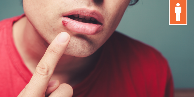 What are Cold Sores? And 5 ways to get rid of cold sores quickly!